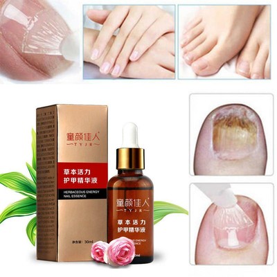 Effective Fungal Nail Treatment Essence Toe Nail Finger ...