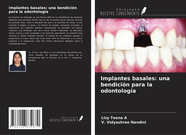 Implantes Basales: Una BendicióN Para La OdontologíA Lizy Teena A-image