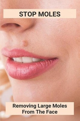 Stop Moles: Removing Large Moles From The Face: Surefire Way To Get Rid Of Moles