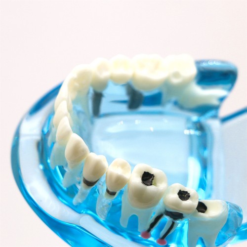 Multiple Types Dental Teeth Model Ortho Implant Practice Teaching Demo Model - Picture 197 of 276