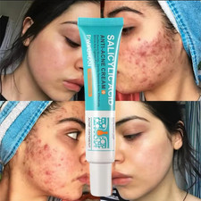Salicylic Acid Strong Acne Removal Cream Anti Acne Pimple Scars Spots Clean US