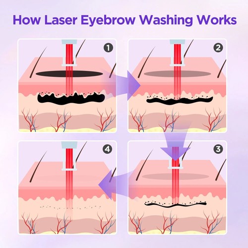 Diode Laser 808nm Painless Hair Removal Nd Yag Pico Laser Tattoo Removal Machine - Picture 4 of 11