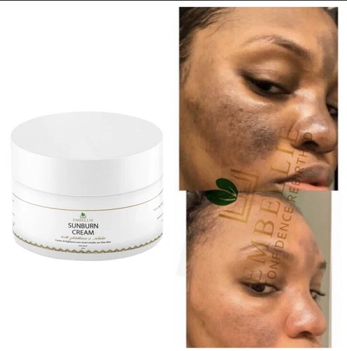 Sunburn Remover Face Cream, Dark Mark Fade Cream - 100ml