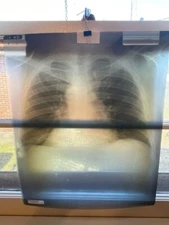 Vintage 1960's - 1970's Chest X-Rays! Lot of 6 Random Images HALLOWEEN ODDITIES!