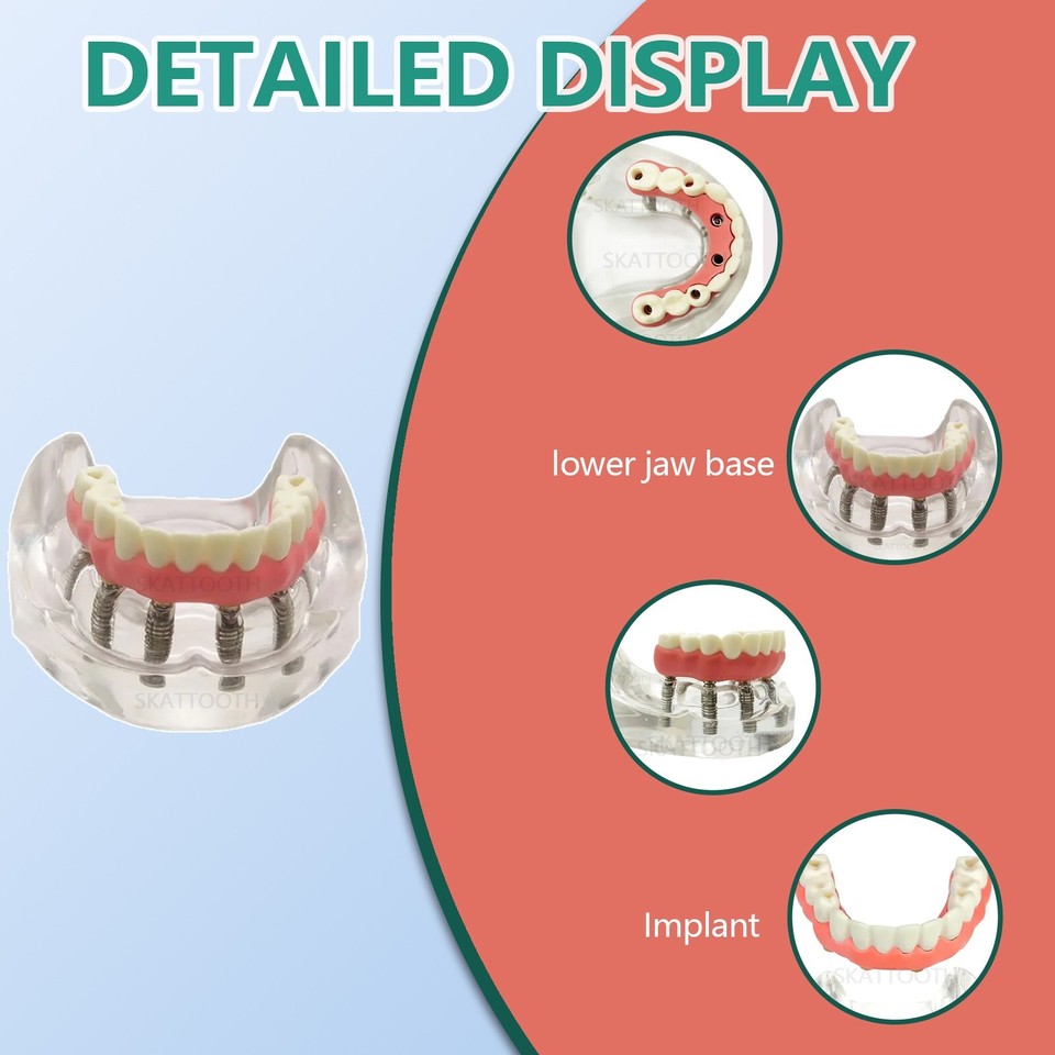 All on 4 dental implants dentures - Full mouth reconstruction abroad