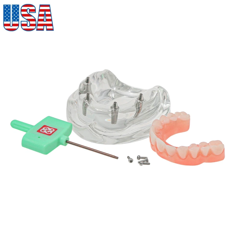 US Dental Overdenture Restoration Teeth Model Upper/Lower Jaw Type With 4/6Screw - Image 3 of 4