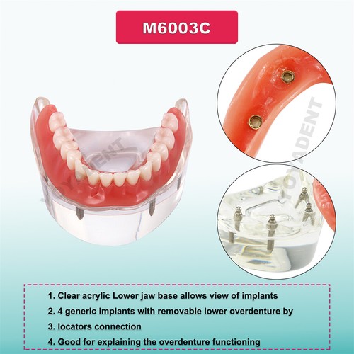 Multiple Types Dental Teeth Model Ortho Implant Practice Teaching Demo Model - Picture 91 of 276
