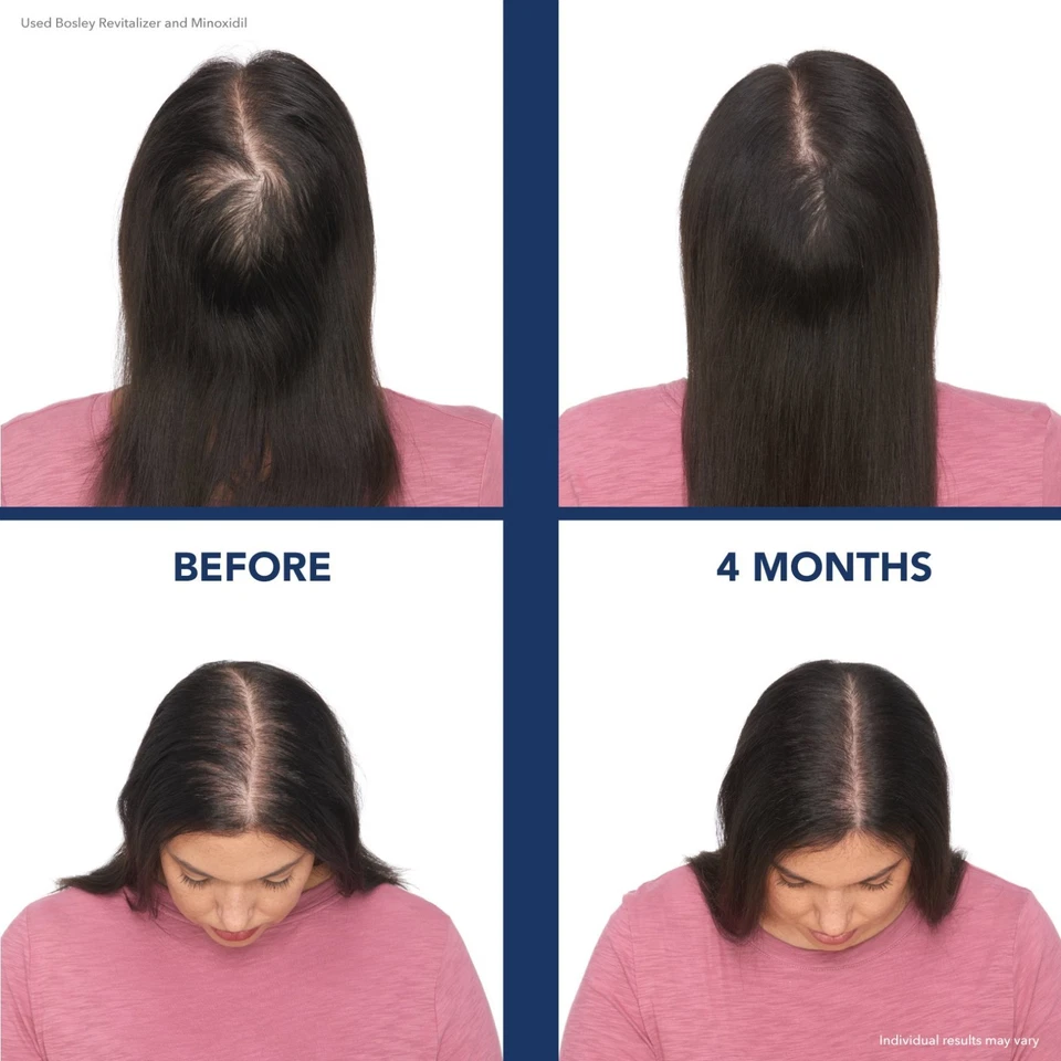 Gorra láser Bosley Revitalizer 164 - Restauración capilar (NUEVA) Foto 2 de 4