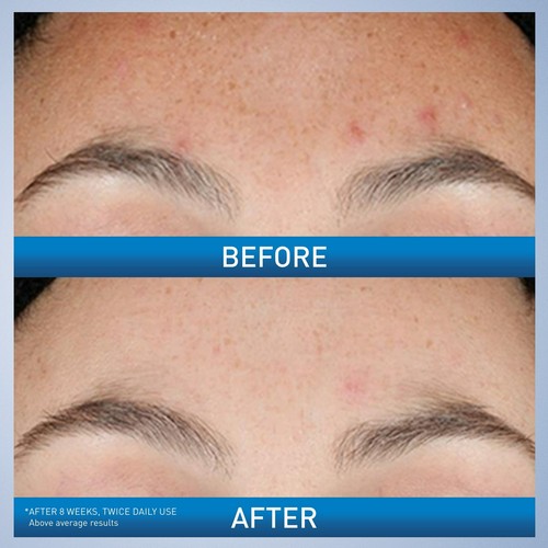 CeraVe Resurfacing Retinol Serum Post-Acne Marks Treatment - 1oz. Each (Pack 6) - Picture 3 of 9