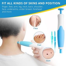 2 in 1 Painless Auto Skin Tag Mole Wart Removal 40x Rubber Bands Alcohol Pads 