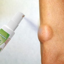 1Pieces Lipomheilung Reduction Spray, 1 Fl Oz LumpFree Lipoma Removal Spray