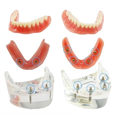 Dental Overdenture Model Using 2/4 Implant Locators On An Lower Arch Demo Model