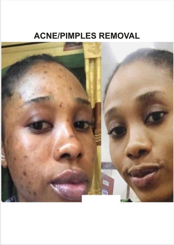 ACNE And PIMPLE FACE TREATMENT SET - Picture 2 of 2