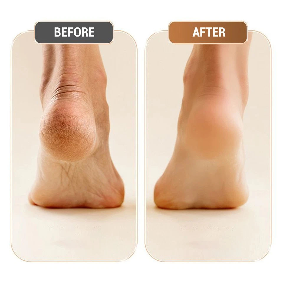 Automatic Electric Foot Callus Remover Foot File Pedicure Tool Battery Powered - Image 3 of 4