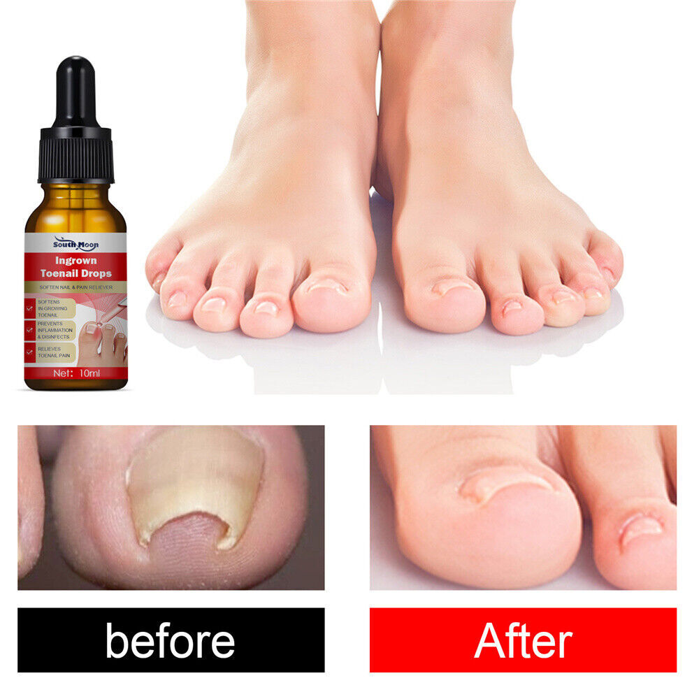 Ingrown Toenail Drops Endogenous Nail Repair Essence Serum Nail Remove