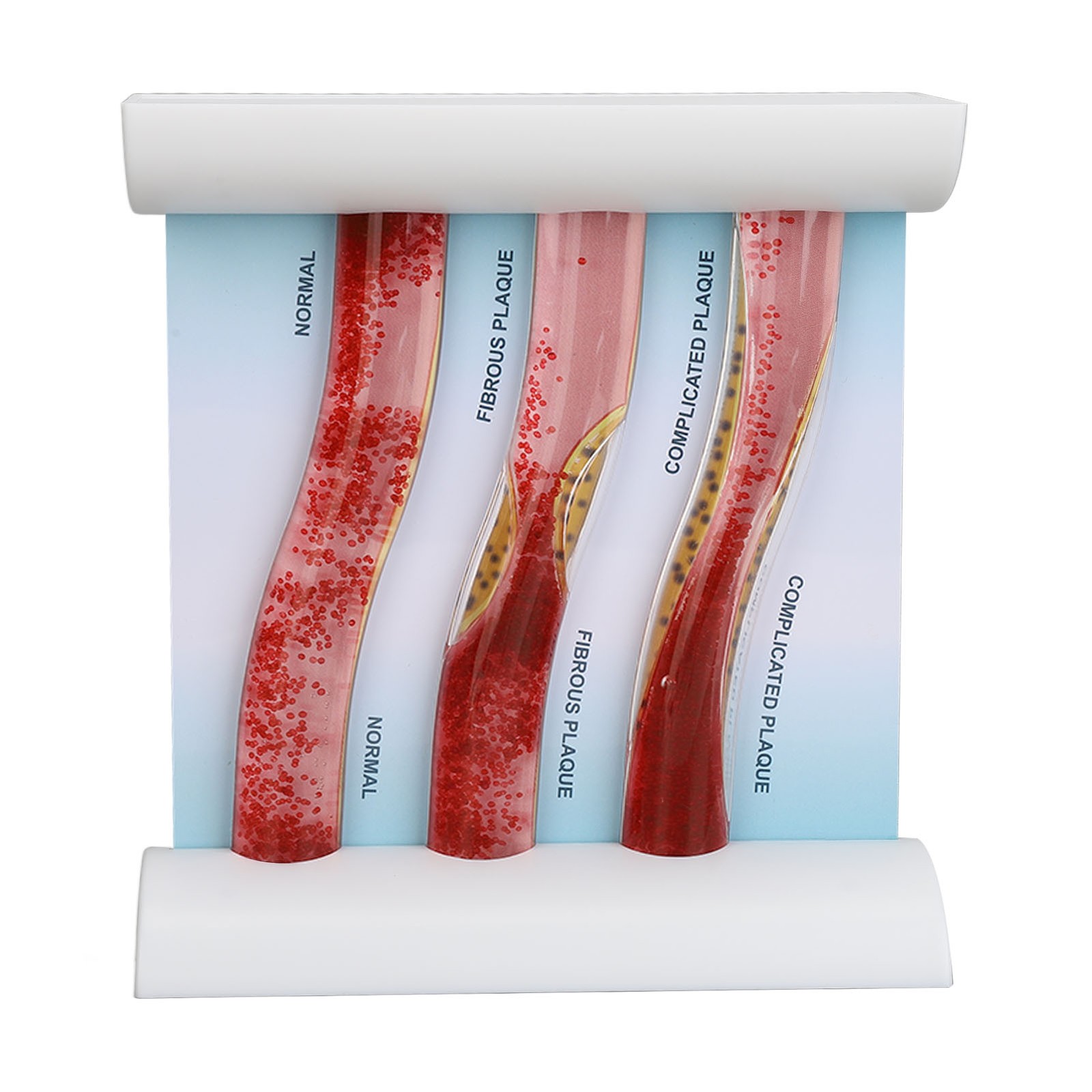 NEW Lipoprotein LDL Blood Vessel Model Low Density Blood Lipid Vessel Obstructio
