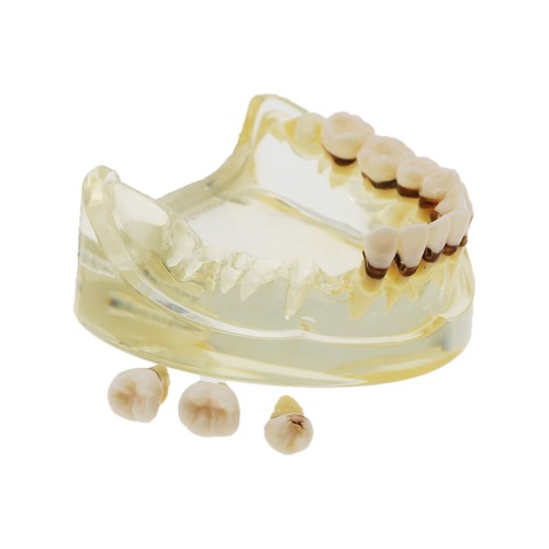 Multiple Types Dental Teeth Model Ortho Implant Practice Teaching Demo Model - Picture 66 of 276