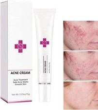 Acne Cream Pimple for Face, Oil Control 0.53 Fl Oz Pack of 1 