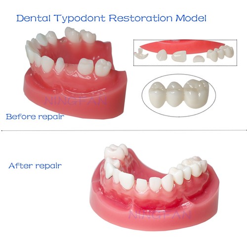 Dental Implant Model Upper Lower Jaw Demo All on 4/6 Overdenture treatment model - Picture 140 of 214