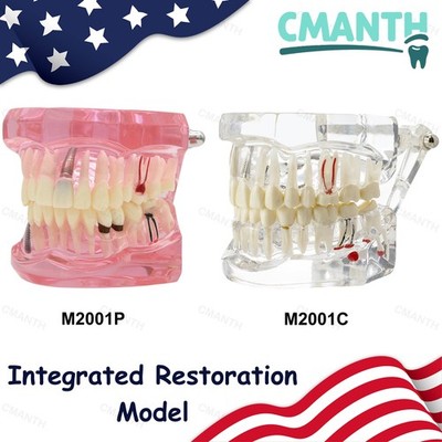 US Dental lmplant Teeth Model Bridge Restoration Pathology Study Demo M2001