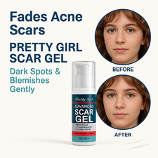 Fades Acne Scars - Pretty Girl Scar Gel, Dark Spots  Blemishes Gently