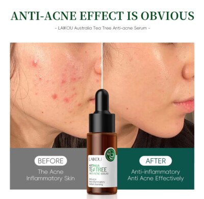 AUSTRALIATES Tea TREE ANTI- ACNE SERUM  Anti-acneAnti-inflammatory