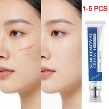 Scar Removal Cream for Stretch Marks, Surgical, Burns Injuries Scars Removal