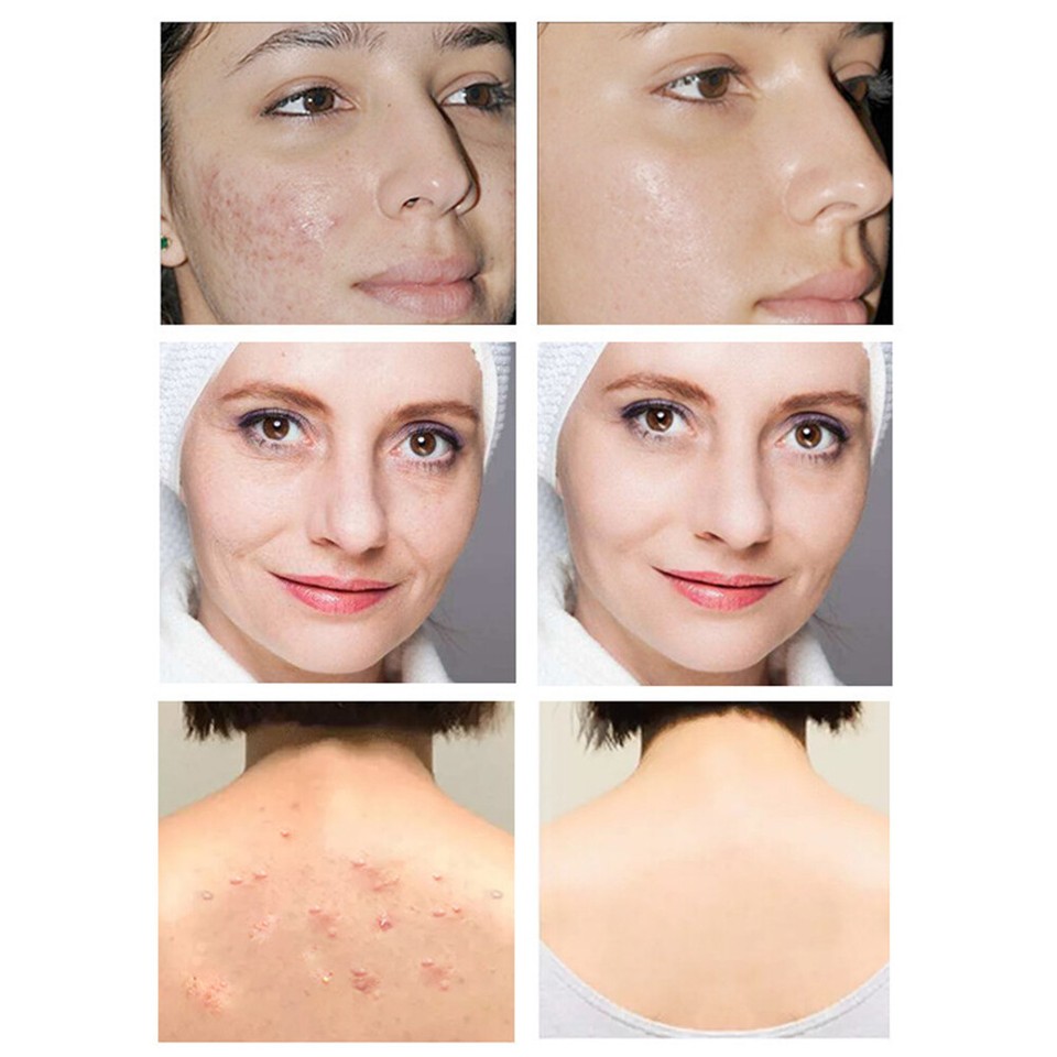 Tumeric Soap Acne Dark Spots Removal Skin Whitening Body Bleaching Soap