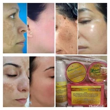 4 In 1 Melasma Set Whitening Remove Dark Sun Spot Hyperpigmentation Wrinkles