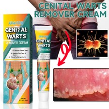 20g 1Pc Genital Warzen Entfernung Creme Haut Behandlung Creme Wart Remover Creme