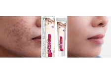 Ayurvedic Herbal Pigmed Cream for Dark spots Acne Scars Pimple Unisex 30gm FS WW