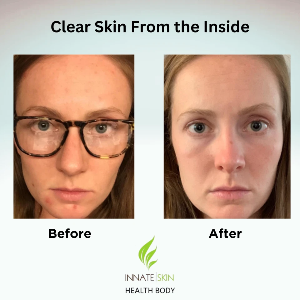 Sistema de acné Clear Skin | 20 productos botánicos, minerales y vitaminas de Innate Skin Foto 2 de 4