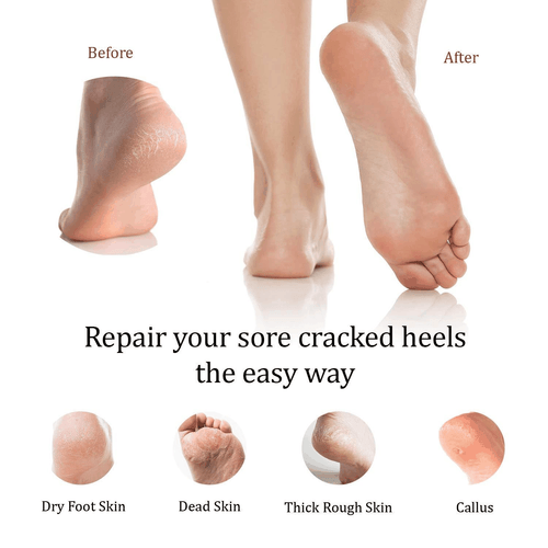 Moisturizing Heel Socks with Soft Gel Lining Dry Cracked Feet Treatment - Picture 4 of 7