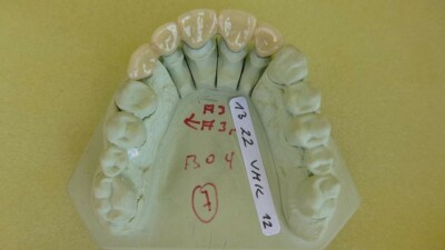 Keramikverblendbrücke auf Sägestumpfmodell abnehmbar Dental Study Model, 