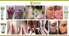 ENDOR ™ Cream is a Steroid Free Treatment for Psoriasis, Eczema and Rosacea. 