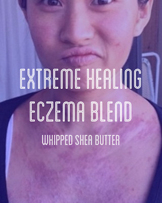 Fra Fra's Naturals | Premium EXTREME Healing Eczema Whipped Shea Butter Blend
