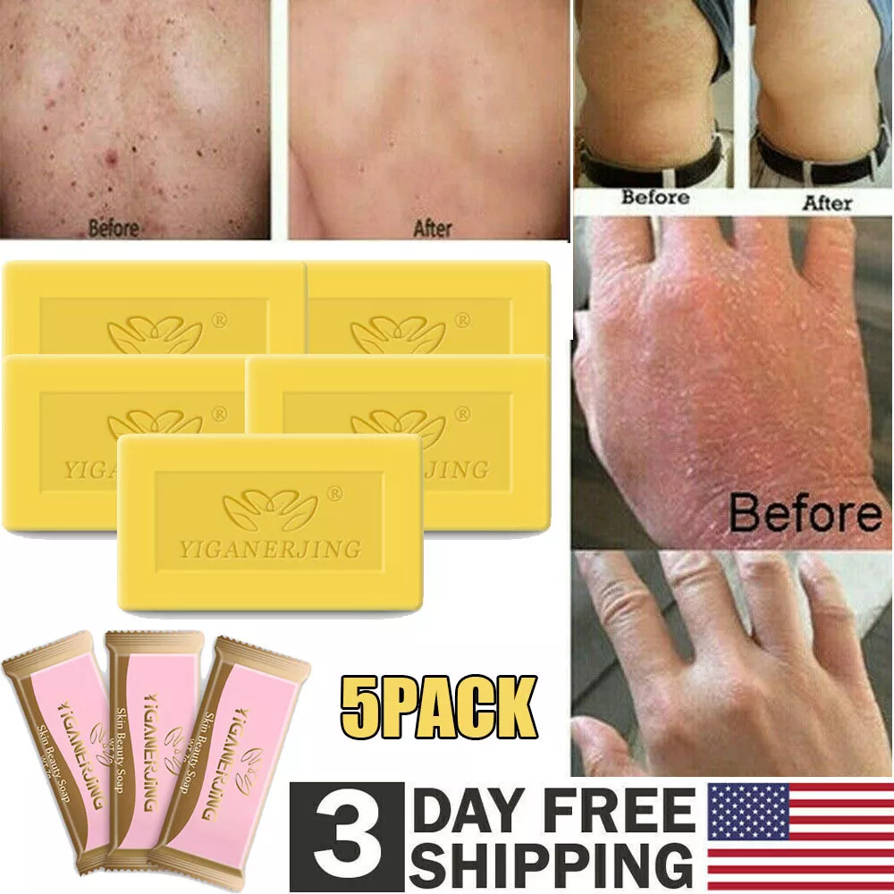 5x Sulfur Soap Skin Cleaning Acne Seborrhea Anti Fungus Bath Soap