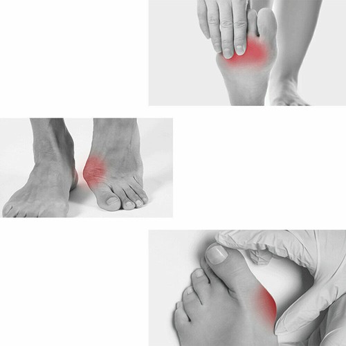 6PCS Silicone Soft Gel Toe Separator Bunion Toes Spacer Orthotics Pain Relief US - Picture 12 of 13