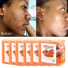 6/5Pcs Turmeric Soap Natural Herbal Ginger Handmade Soap For Acne And Dark Spots