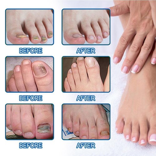60x Toenail Fungus Treatment Sticker Nail Repair Patches Treatment Tool Kit Hot - Bild 7 von 12