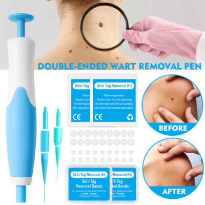 2-IN-1 Auto Skin Tag Removal Tool Kit Painless Skin Label Mole Acne Wart Removal