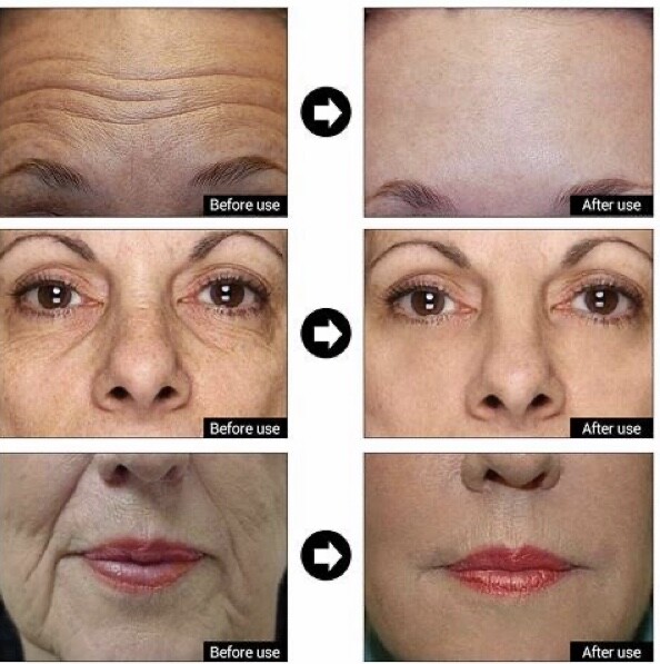 matrixyl 3000 glp 1 Hyaluronic Acid + Matrixyl 3000 Peptide Gel Cream Face & Eye Wrinkle Serum