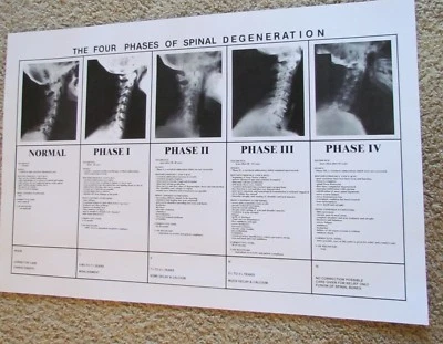 Chiropractic phases of spinal degeneration poster - Photo 1/3