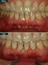 Extra Strength Super Potent Gum Disease Cure Stop Bleeding Receeding Gums Teeth
