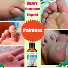 30ML Wart Remover Liquid Skin Tag Mole Remover Eliminate Foot Corn Warts Unisex