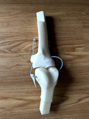 Left Knee Insert Tibial Adjustable Neutral - MITA Bionics - Medical Model