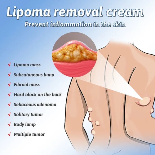 1-5X Spray Reductor Lipomheilung, Spray Eliminador Instantáneo de Lipomas Sin Grumos NUEVO - Imagen 4 de 12