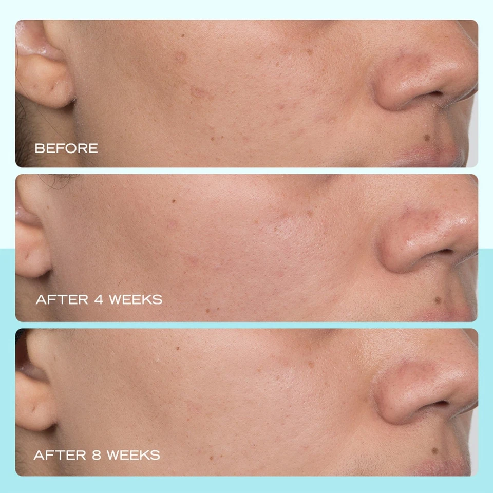 First Aid Beauty - Suero para manchas oscuras con niacinamida, ayuda a reducir el aspecto de Dar... Foto 4 de 4