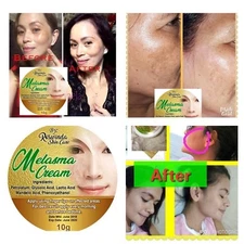 Melasma Remover Cream Freckles Dark Spot Diminish Sun damage Micro Peeling