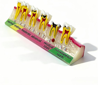 6-Stage Dental Caries Development Model - Anatomical Teeth Decay Demonstration w